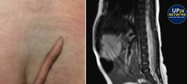 बच्चे की कमर पर उगी पूंछ, उम्र के साथ बढ़ती गई