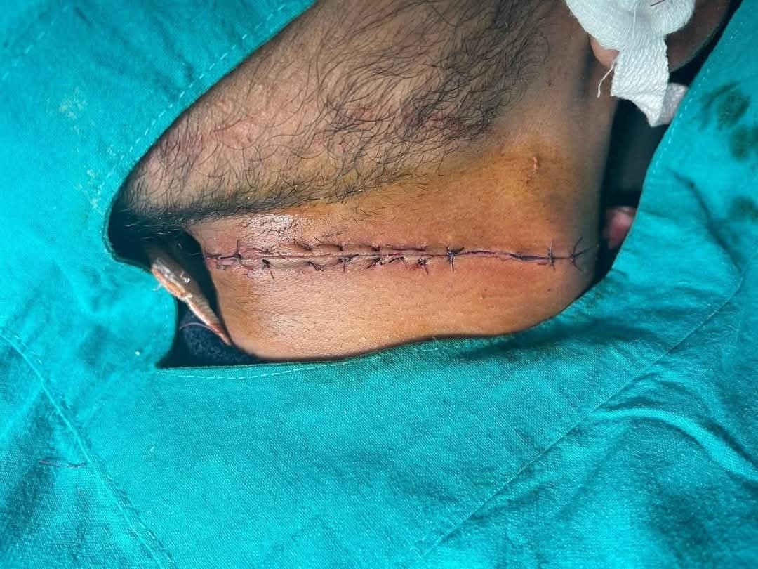 Lucknow Manja Accident: गर्दन पर गंभीर कट, बची जान