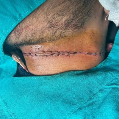 Lucknow Manja Accident: गर्दन पर गंभीर कट, बची जान