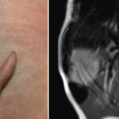 बच्चे की कमर पर उगी पूंछ, उम्र के साथ बढ़ती गई